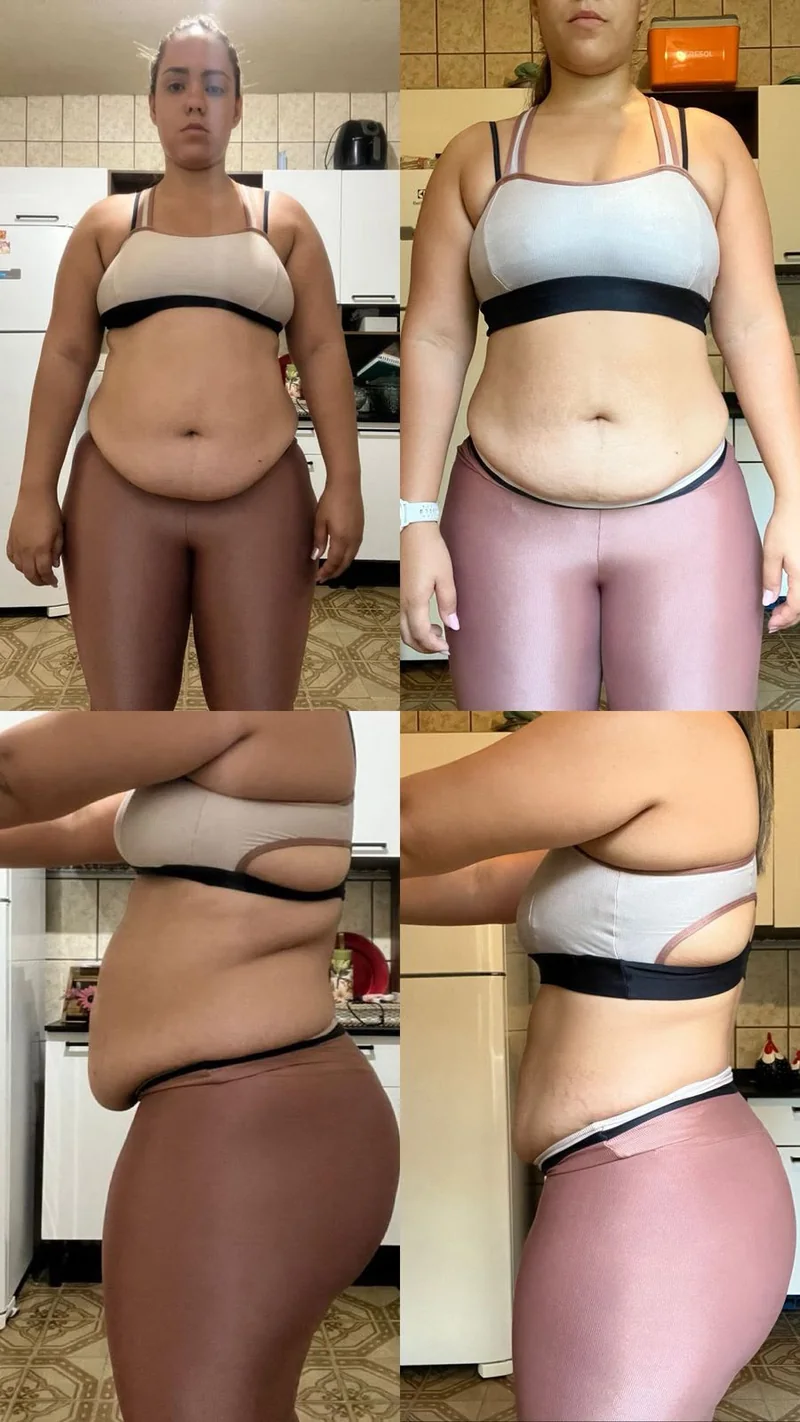 Comparação frontal e lateral de acompanhamento autorizada, antes e depois